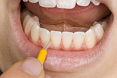 Zwischenraumreinigung der Zähne mit Interdentalbürstchen
