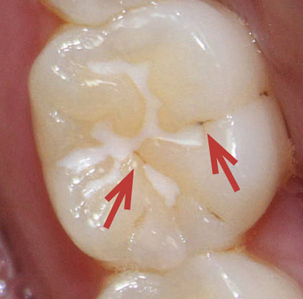 Schwarze Punkte Auf Den Zähnen