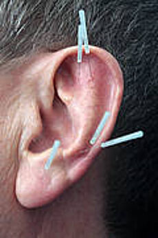  Akupunkturnadeln im linken menschlichen Ohr