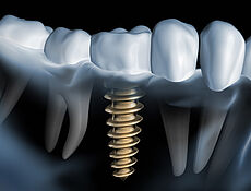Zahnreihe mit einem Implantat