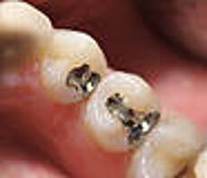 Zwei Zähne mit Amalgamfüllungen