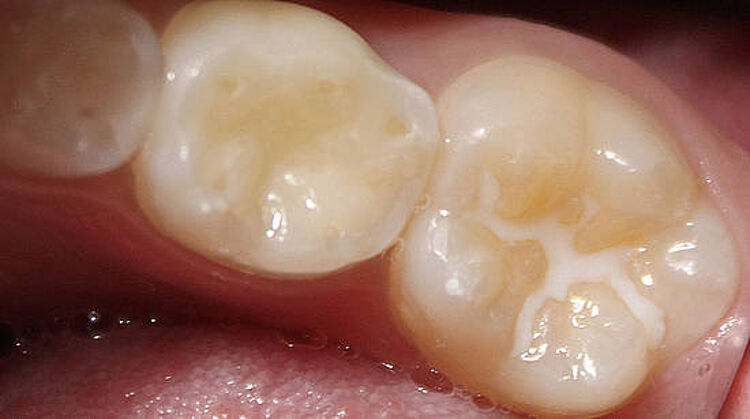 Rausgefallen was tun zahnfüllung Zahnfüllung Behandlungen