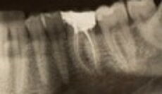 Röntgenbild mit Zähnen