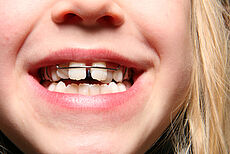 Halbgeöffneter Kindermund mit einer Zahnspange