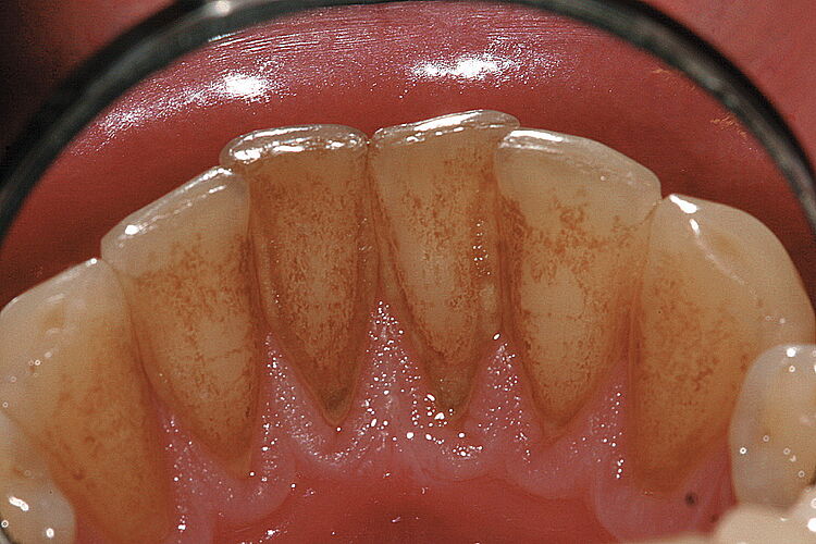 Innenansicht der unteren Schneidezähne mit Zahnbelägen aus Genussmitteln, wie Tee, Kaffee und Tabakrauch