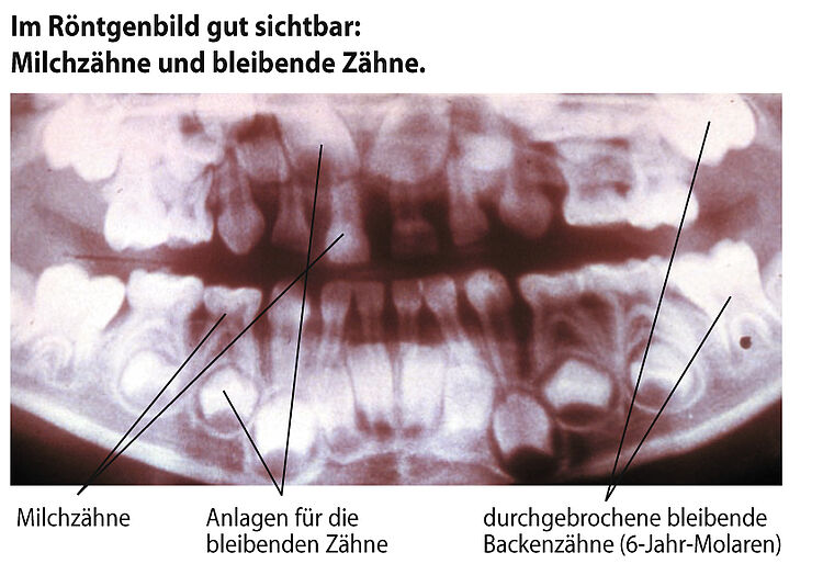 Röntgenbild Milchzähne und bleibende Zähne
