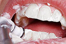 Zähne werden poliert
