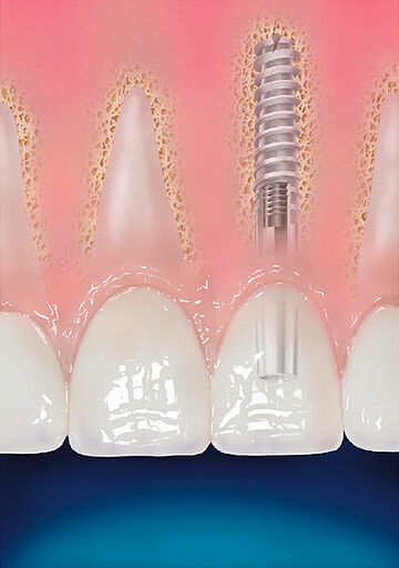 Zähne mit einem Implantat