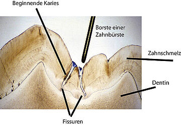 Schematische Darstellung einer Fissur in einer Zahnkrone