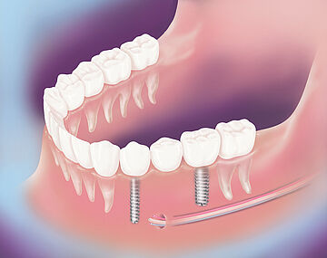 Geschlossene Zahnlücke mit Implantaten