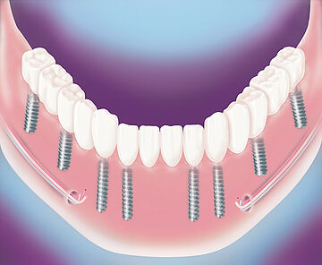 Festsitzender Zahnersatz mit acht Implantaten