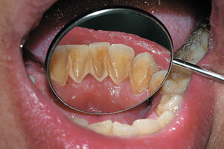 Ein Mundspiegel zeigt die Innenansicht von unteren Schneidezähnen mit Zahnsteinbelägen