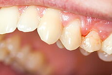 Seitliche Ansicht von Zähnen mit Zahnfleischbluten