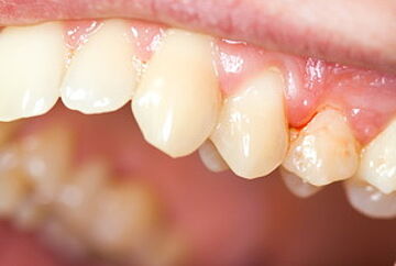 Geschwollenes und leicht blutendes Zahnfleisch einer Zahnfleischentzündung