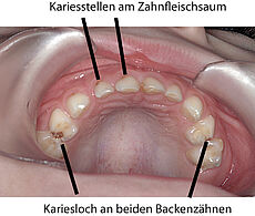 Karies an Milchzähnen